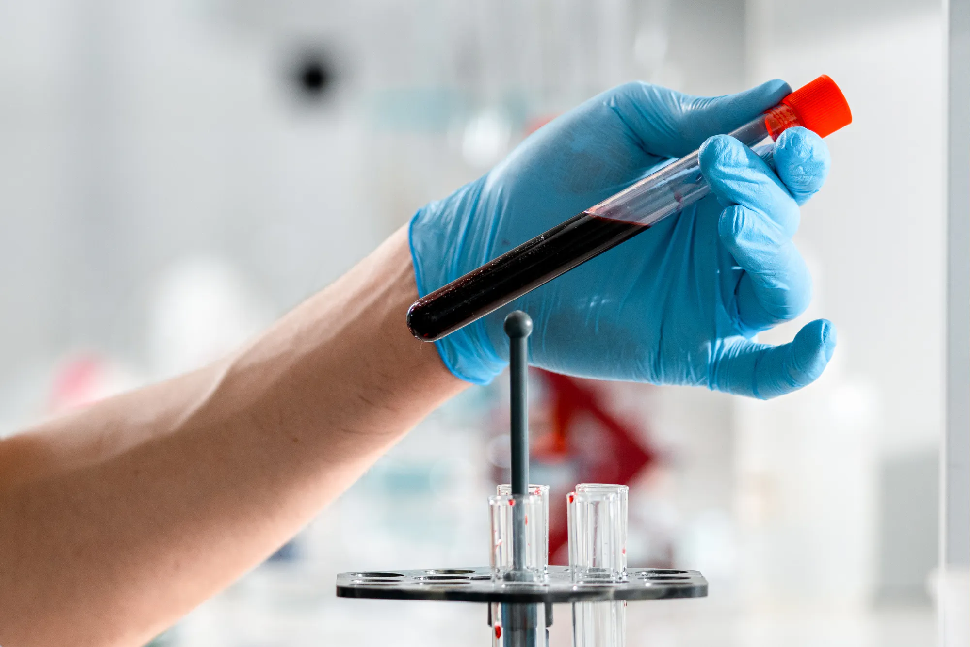 A gloved lab technician holds a tube of dark blood beside a specimen rack, representing the multi-cancer early detection blood test evaluated in the NHS-Galleri study.